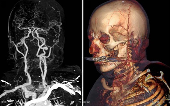 three material decomposition can be used to better differentiate tissue and material
